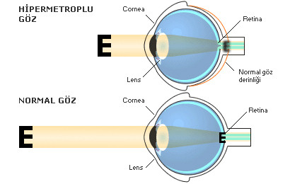 Hipermetropi