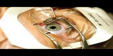 Miyop Göz Ameliyatı