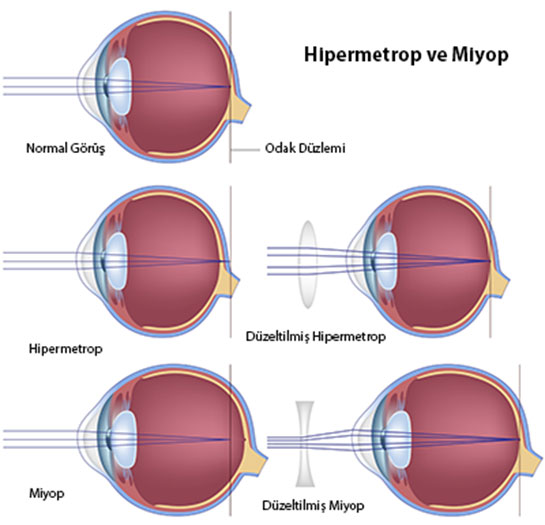 Miyop Hipermetrop